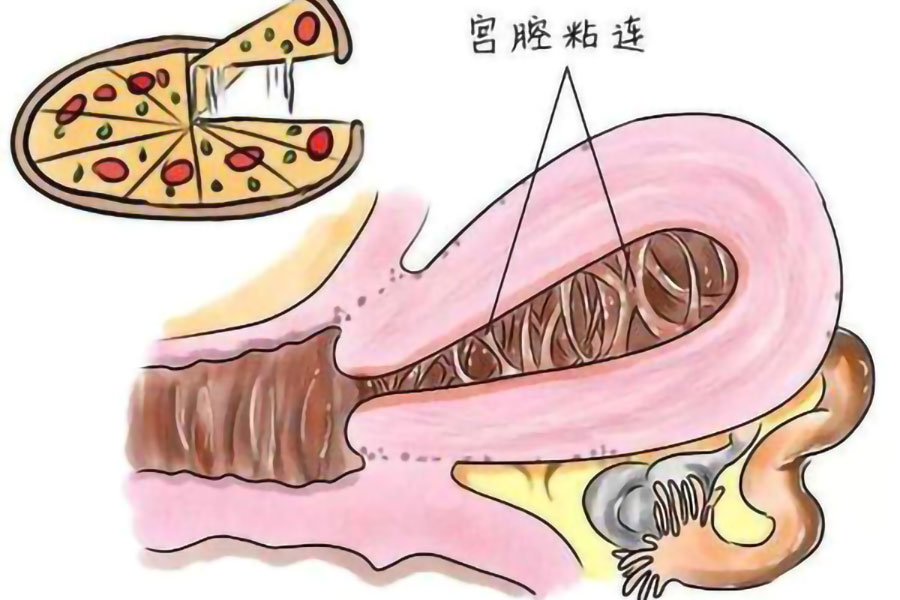 宫腔粘连900.jpg
