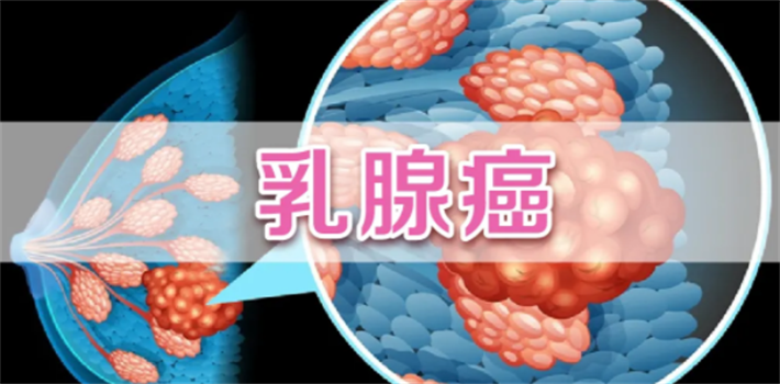 乳腺癌