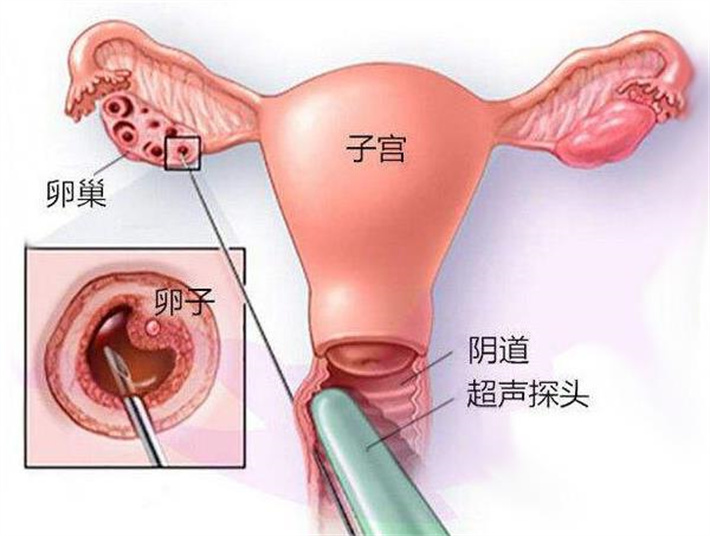 卵巢取卵.jpg