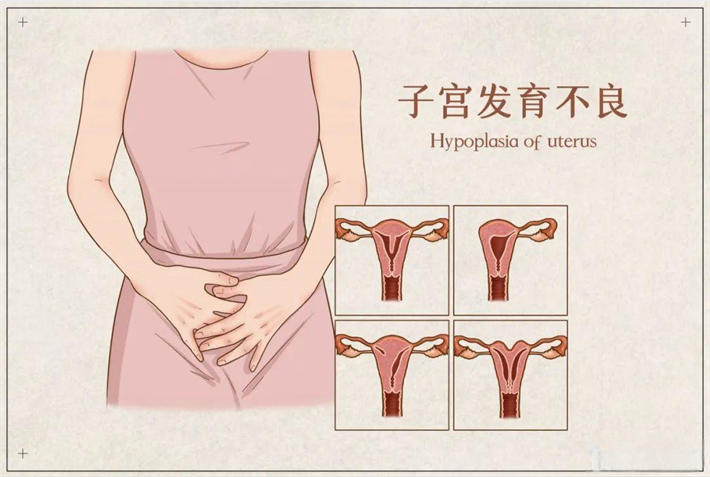 子宫发育不全.png