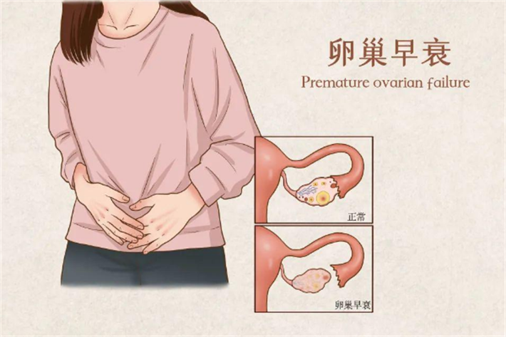 卵巢功能衰竭2.png