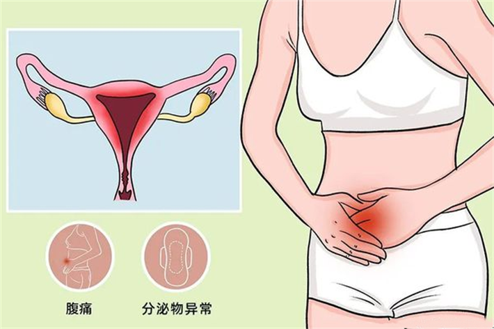 盆腔感染.png