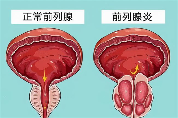 前列腺炎.png