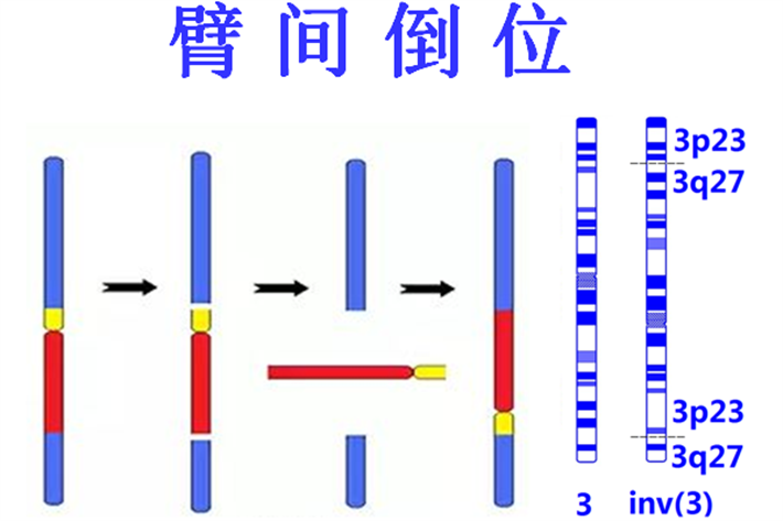 染色体臂间倒位能做第三代试管婴儿吗？染色体臂间倒位是一种常见的染色