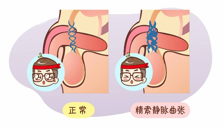精索静脉曲张