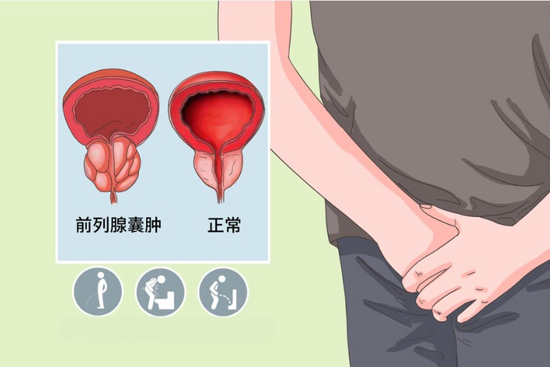 前列腺囊肿