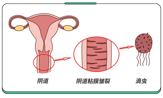 滴虫性阴道炎