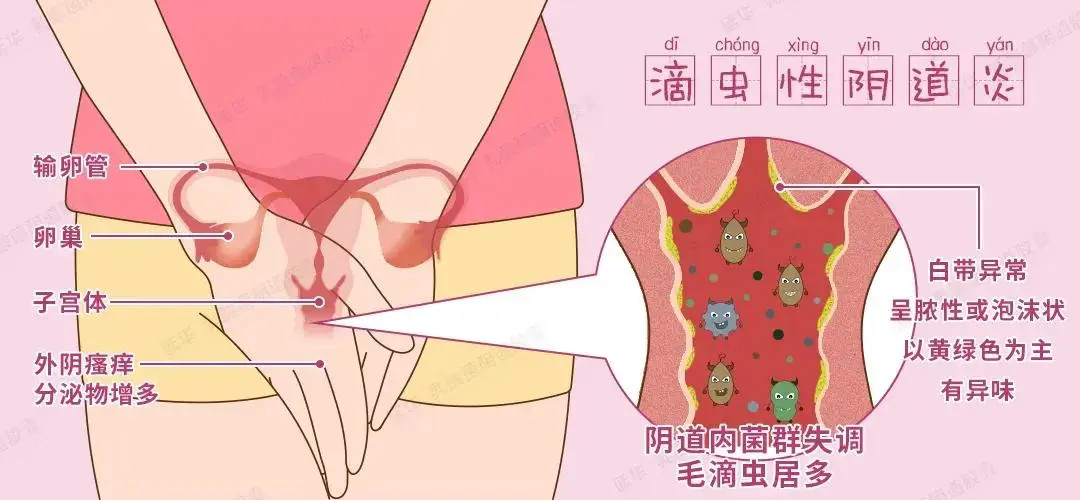 滴虫性阴道炎