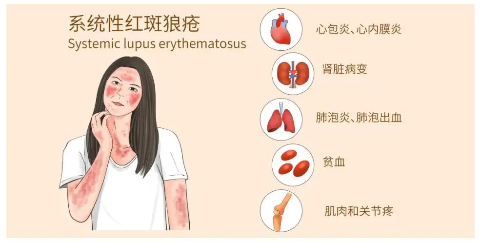 系统性红斑狼疮