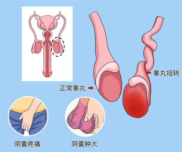 睾丸扭转