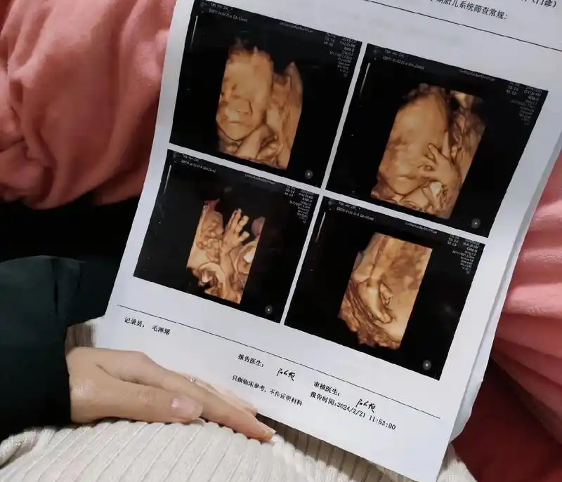四维彩超