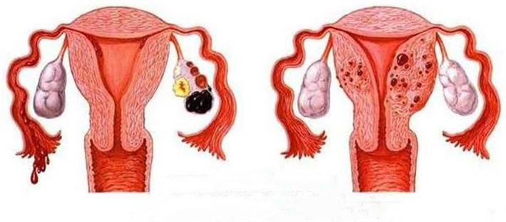 卵巢子宫内膜异位囊肿