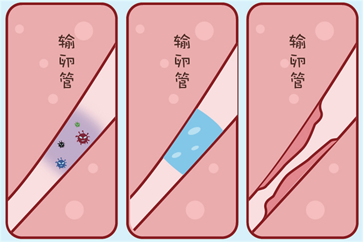 输卵管积水