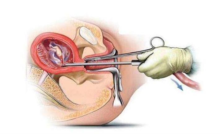 人流手术