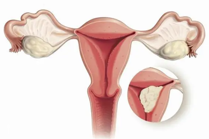 慢性子宫内膜炎