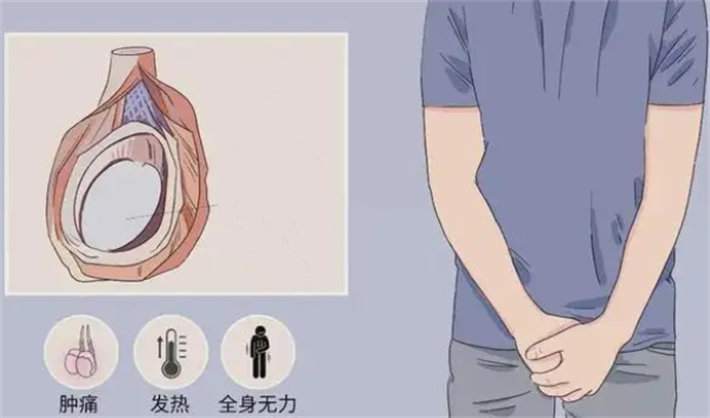 附睾炎