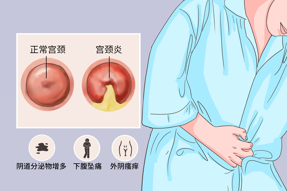 宫颈炎