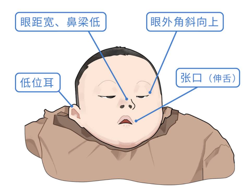 唐氏综合征表现