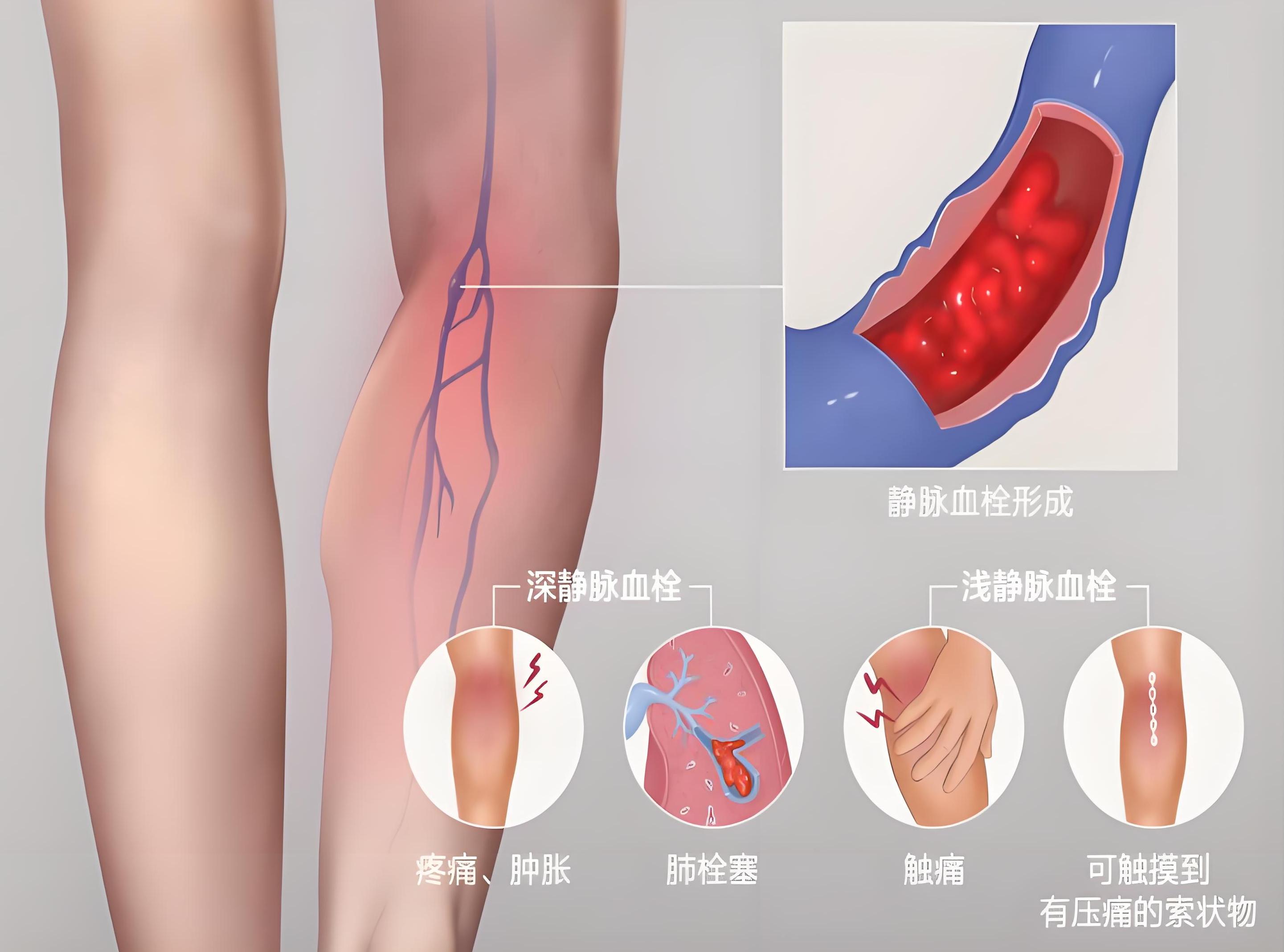 下肢静脉血栓