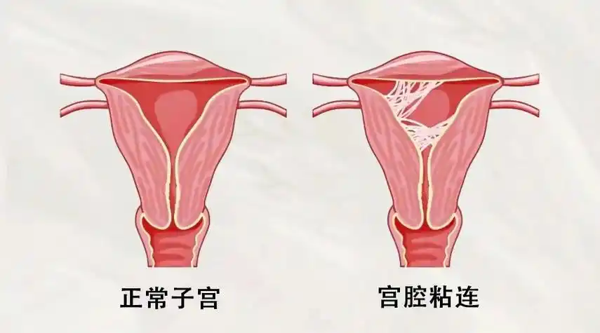 宫腔粘连