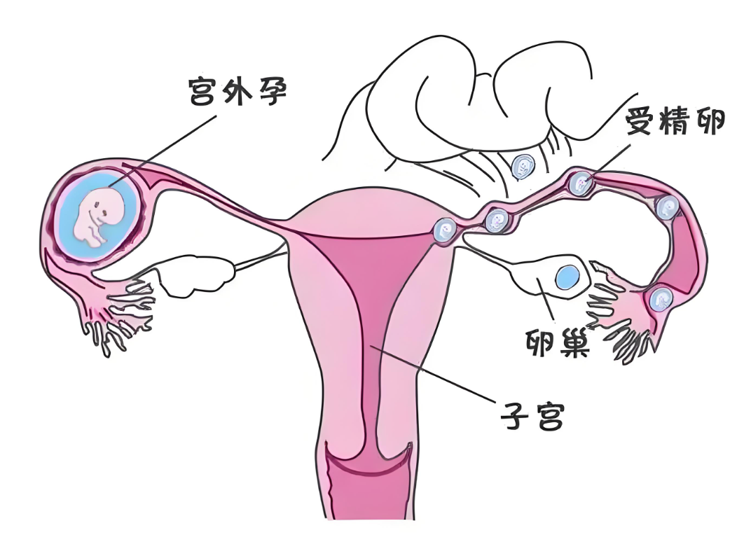 宫外孕
