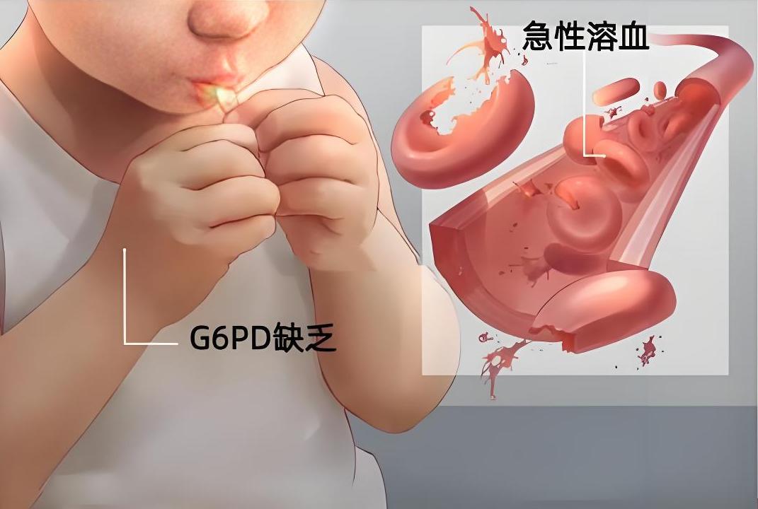 蚕豆病