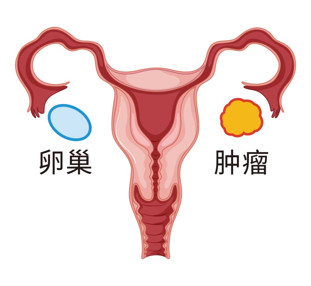 卵巢肿瘤