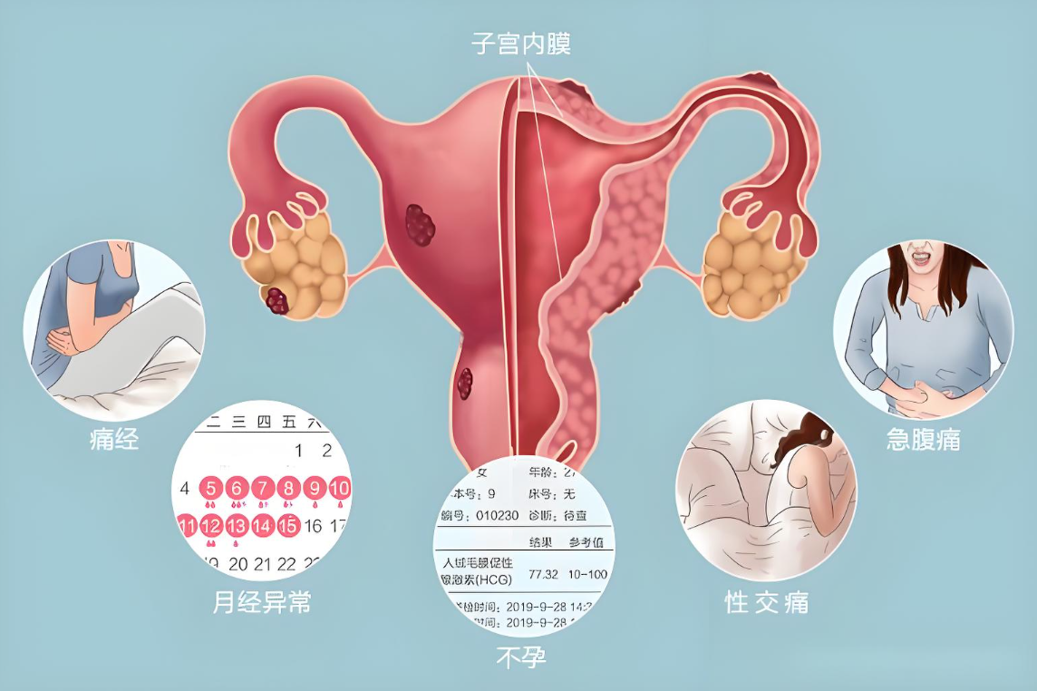 子宫内膜异位症表现