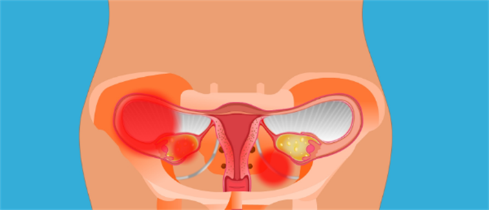 子宫附件炎