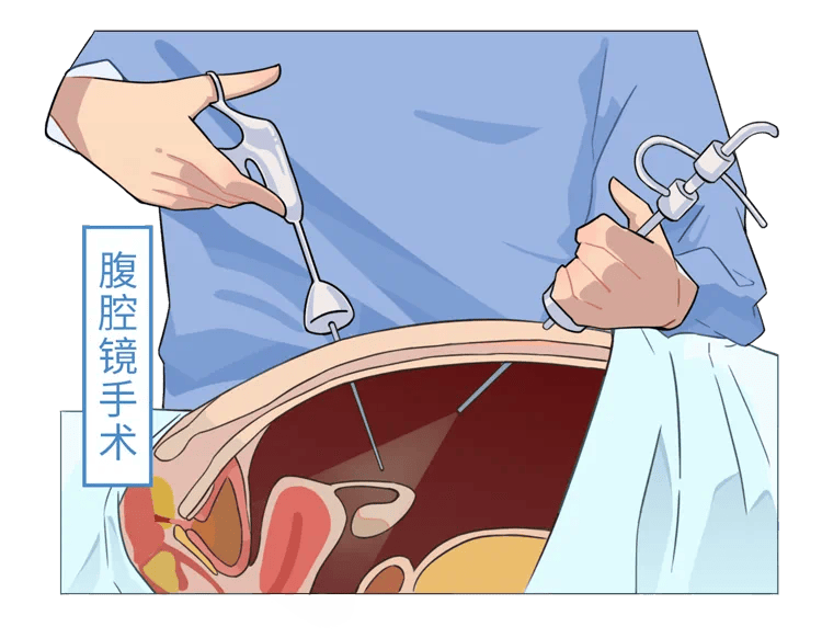 腹腔镜疏通手术