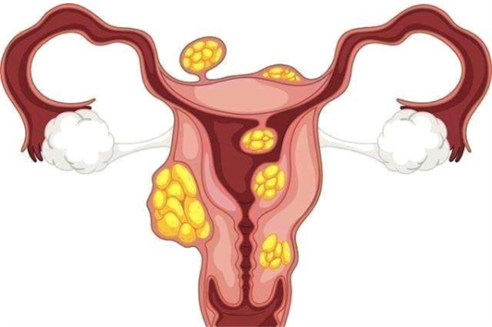 子宫问题子宫肌瘤