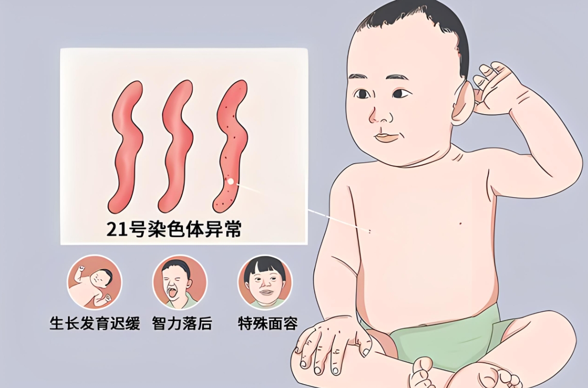 唐氏综合征.png