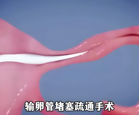 输卵管堵塞疏通手术