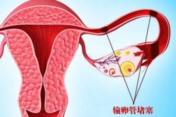 输卵管堵塞.jpg
