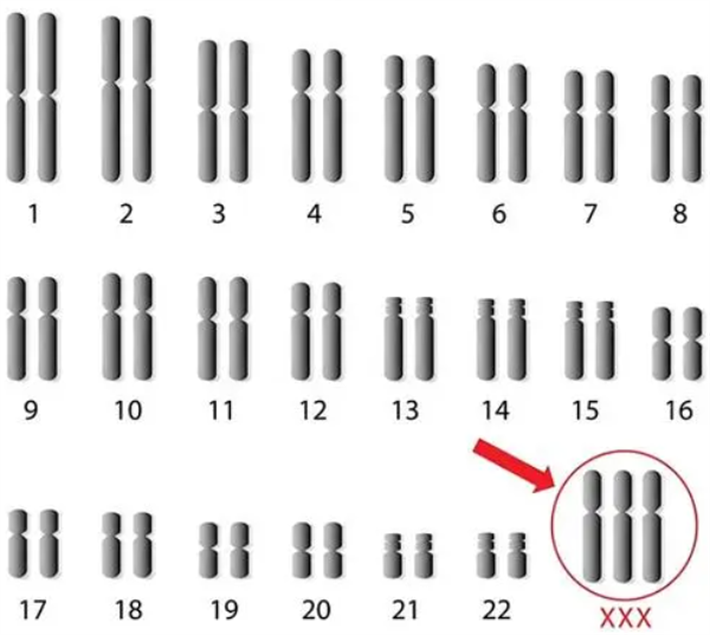 染色体异常