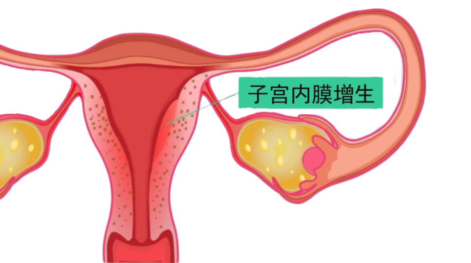 子宫内膜增生