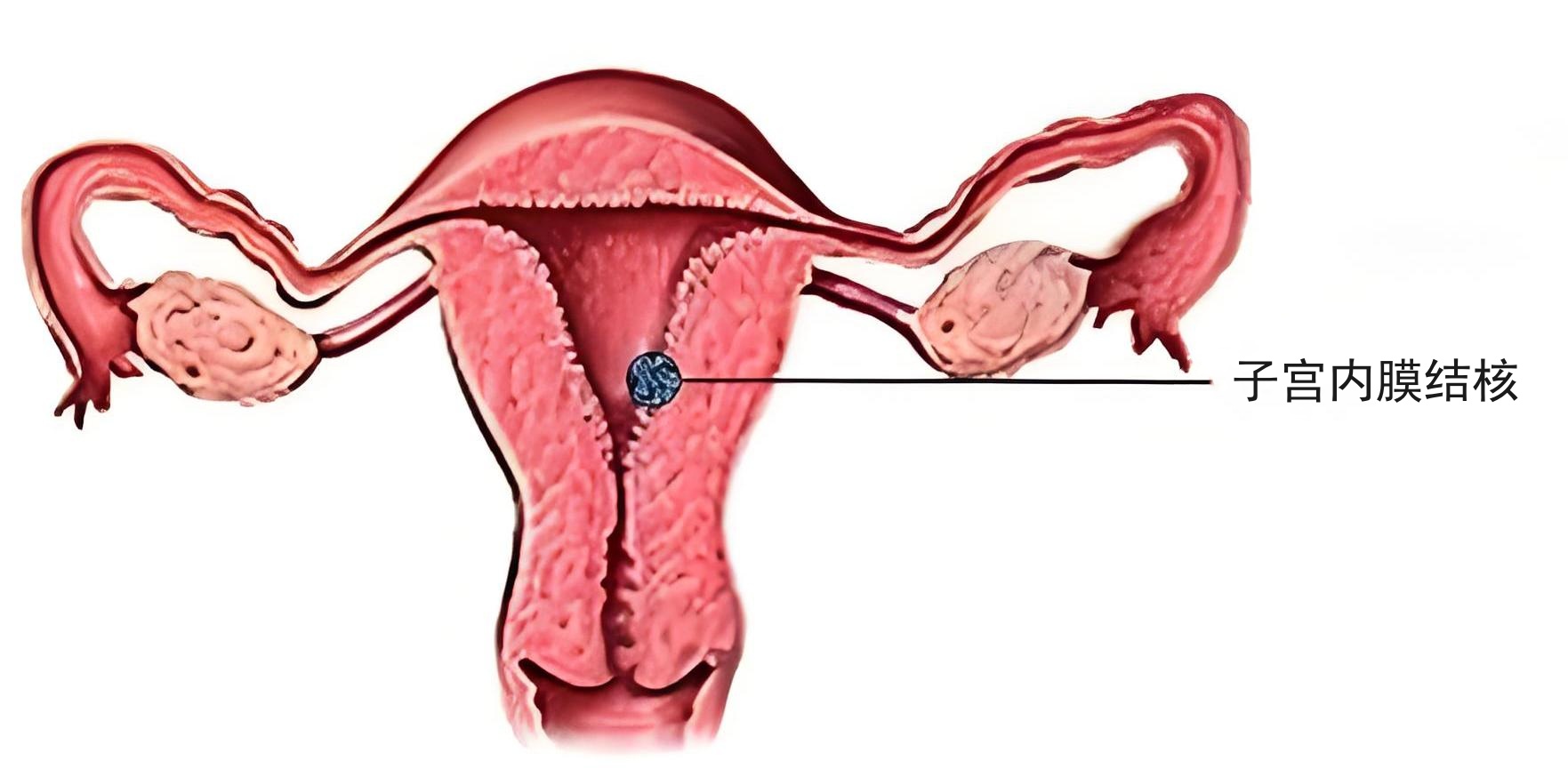 子宫因素
