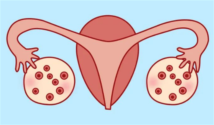 多囊卵巢综合征