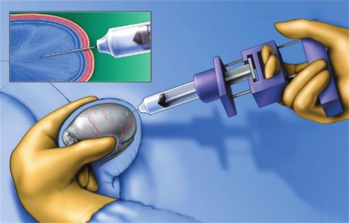 睾丸穿刺取精术