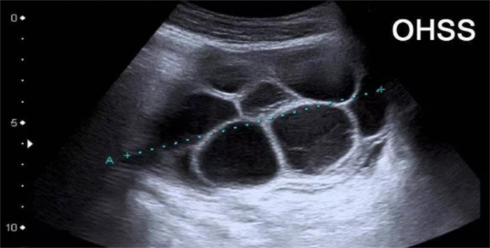 取卵过晚造成卵巢过度刺激综合征
