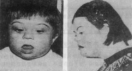 爱德华氏综合征