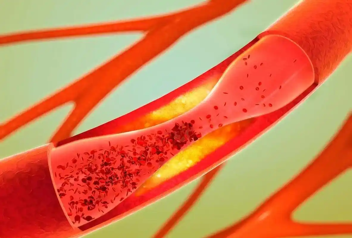 导致血管微血栓形成