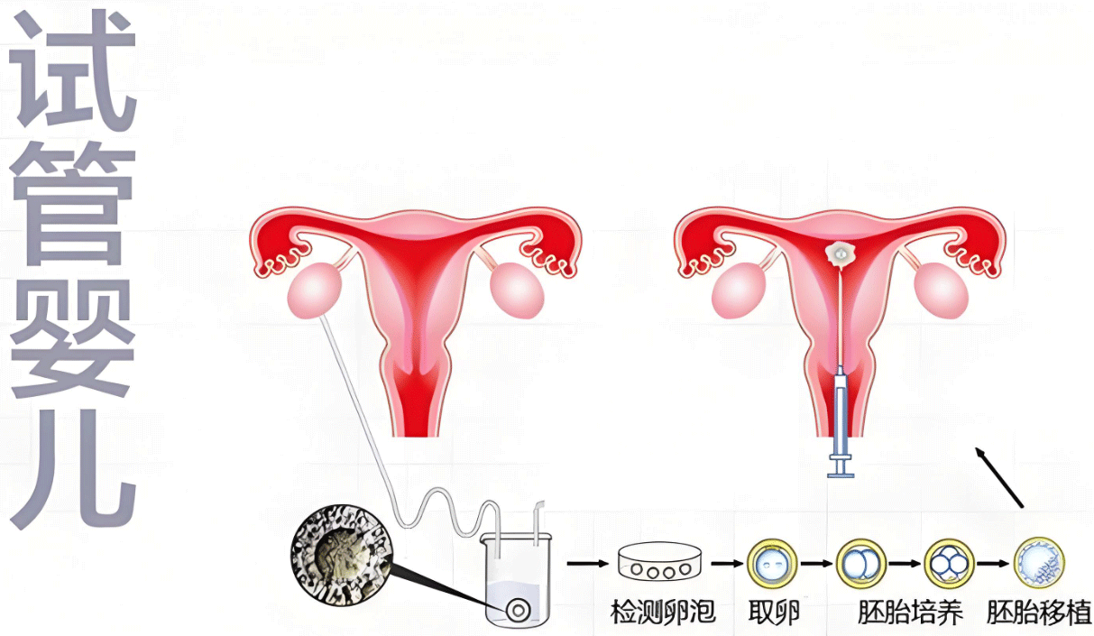 试管婴儿技术