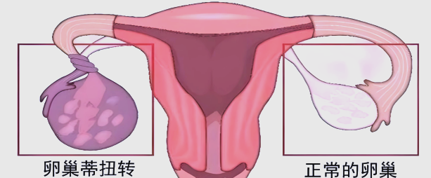 卵巢扭转