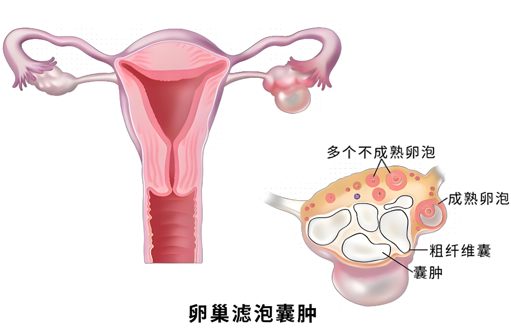 卵巢滤泡囊肿