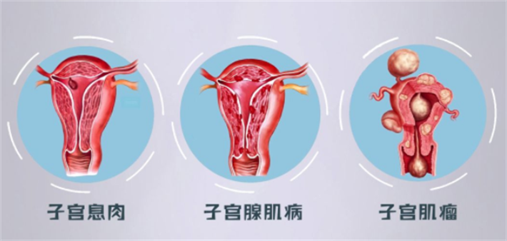子宫肌瘤 子宫息肉