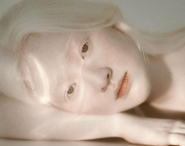 白化病相关综合征