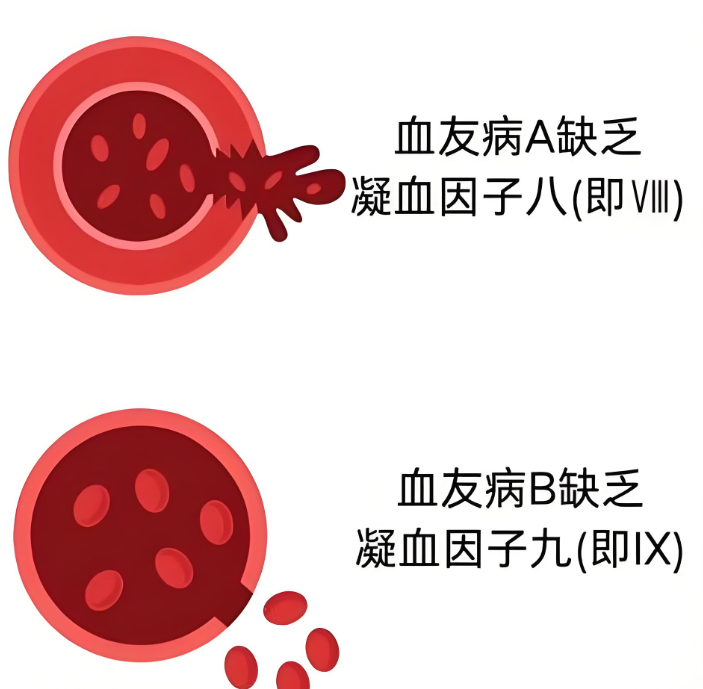 血友病