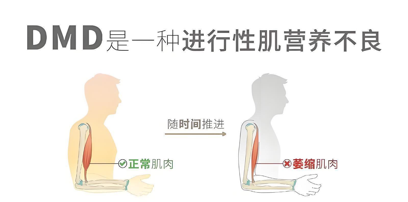杜氏肌营养不良症