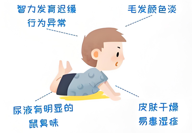 苯丙酮尿症